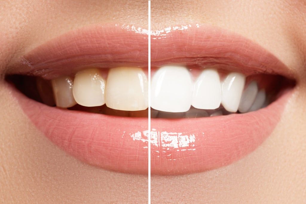 Før og efter tandblegning hos Tandkunsten
